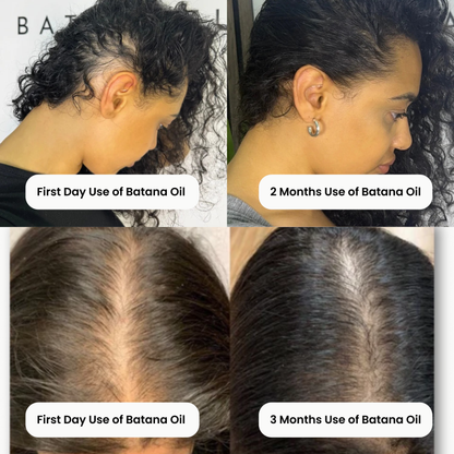 RootRise™ Batana Oil Bundle– Free Liquid Oil Included